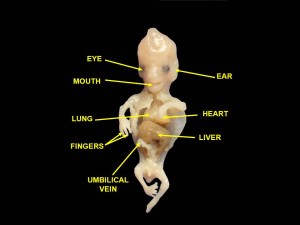 This is a 38mm embryo, deceased at 8-9 weeks, which is at the upper end of the age we're talking about. We hesitate to include images of dissected people on De Civitate, but, as with *any* medical discussion, it's difficult for the lay reader to understand the topic without it.